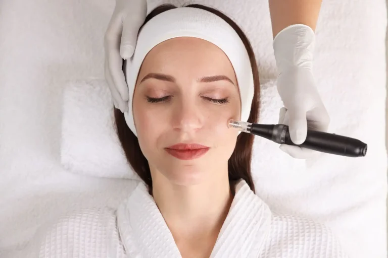microneedling